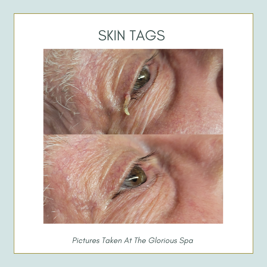 ThermaVein - image_1