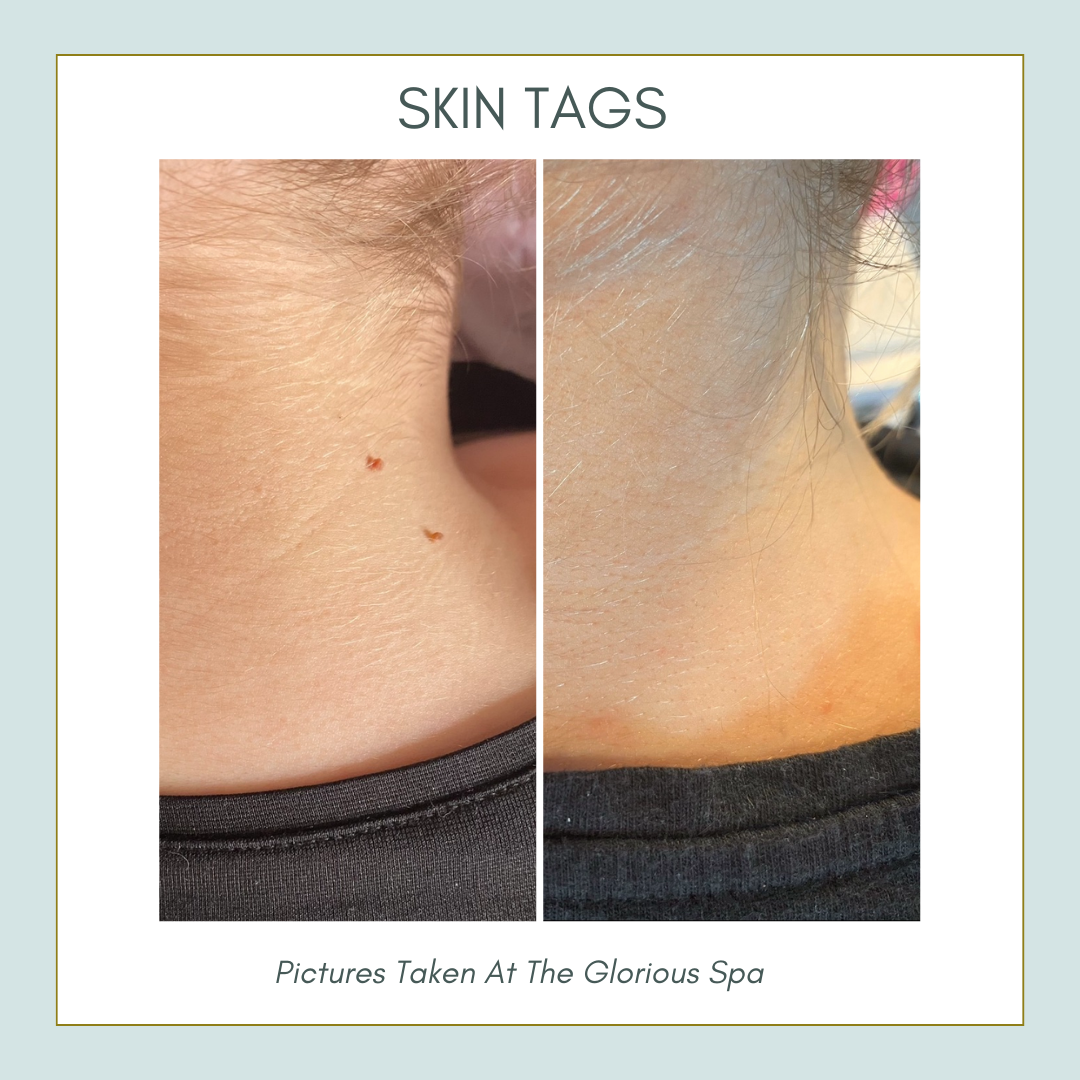 ThermaVein - image_2