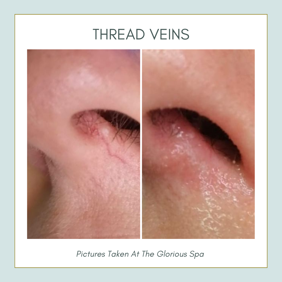 ThermaVein - image_3