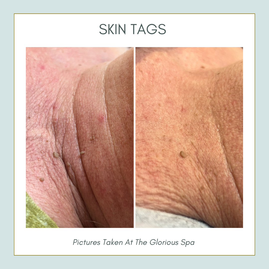 ThermaVein - image_4