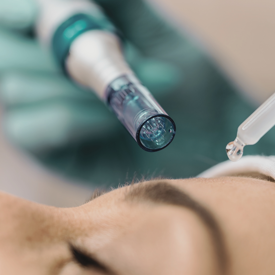 Micro Needling Image